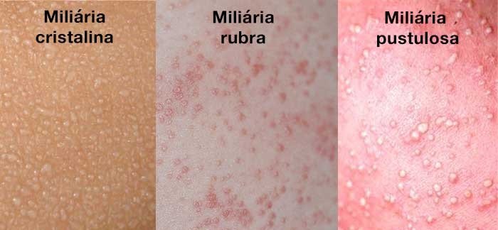 Tipos de Brotoeja no Bebê